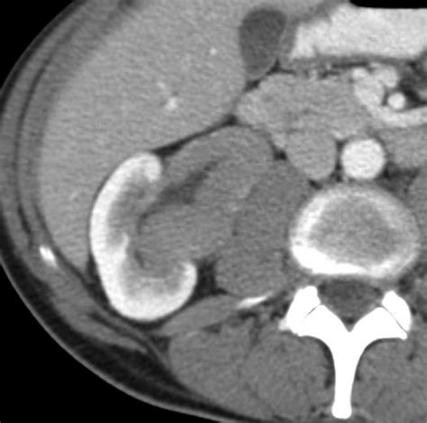 Renal Cell Carcinoma Ct Wikidoc