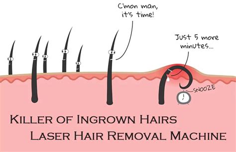 Killer Of Ingrown Hairs Laser Hair Removal Machine Stelle Laser