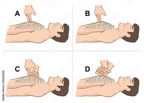 First Aid Resuscitation Cpr Massage Compression The Chest Stock Vektorgrafik Adobe Stock
