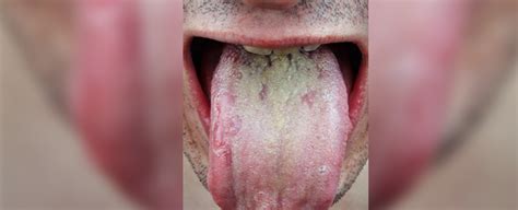 Sie wird durch das herpes virus ausgelöst und auch als gingivostomatitis herpetica bezeichnet. Mundfäule