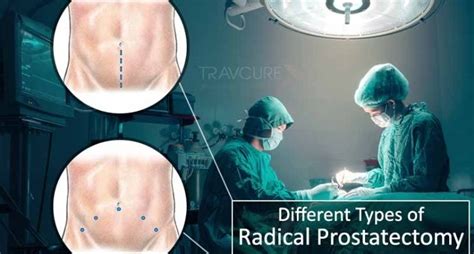 Different Types Of Radical Prostatectomy Procedures To Choose From