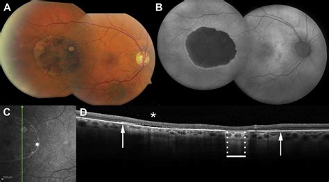 Congenital Hypertrophy Of The Retinal Pigment Epithelium Ophthalmology