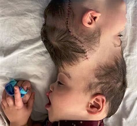 Conjoined Twins Born With Fused Brains Separated After 27 Hour Surgery