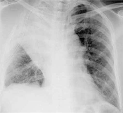 Figure 1 From Pulmonary Torsion Following Right Upper Lobectomy