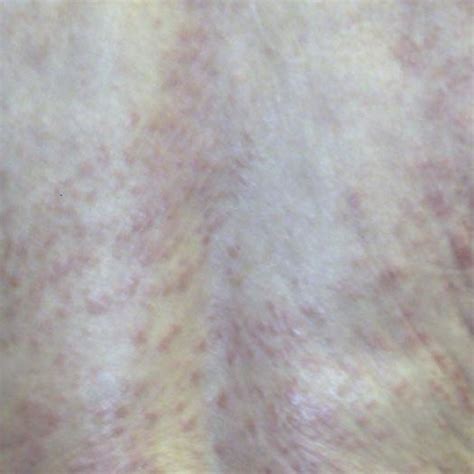 2 3 And 4 Psoriatic Skin Changes Scaly Erythematous Plaques On Trunk