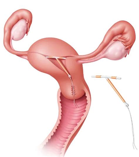 Iud Contraceptive Device Types Insertion Removal Risks Side Effects
