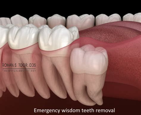 Emergency Wisdom Teeth Removal Ventura CA California Same Day Symptoms Insurance
