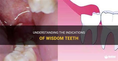 Understanding The Indications Of Wisdom Teeth Medshun