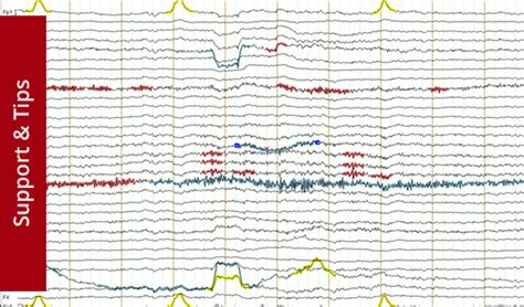 Getting To Know Eeg Artifacts And How To Handle Them In Brainvision Analyzer