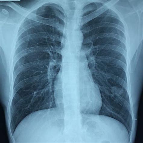 Chest Radiograph Showed A Lobulated Radio‐opaque Mass In The Left Lower