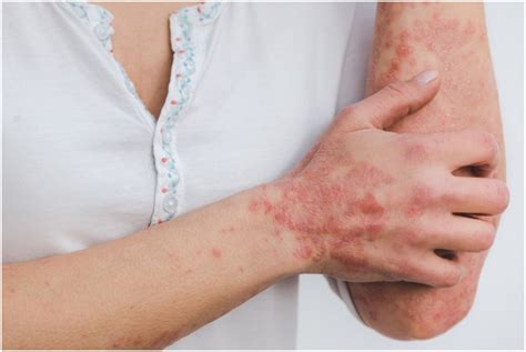4 Causes Of Skin Inflammation And How To Treat Them