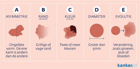 Het Herkennen Van Huidkanker Skn Cosmetische Dermatologie Utrecht