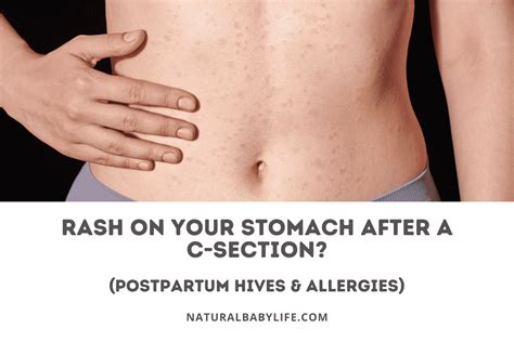 Rash On Your Stomach After A C Section Postpartum Hives Allergies