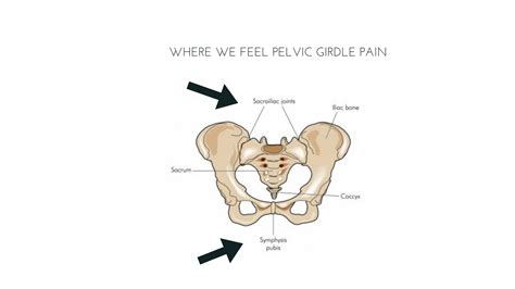 Pelvic Girdle Pain The How What And Why Of It