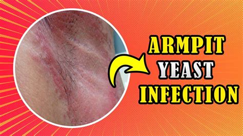 How To Treat Armpit Yeast Infection Candida At Home Youtube