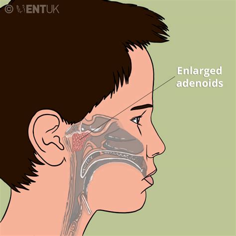 Adenoid Surgery Ent Uk