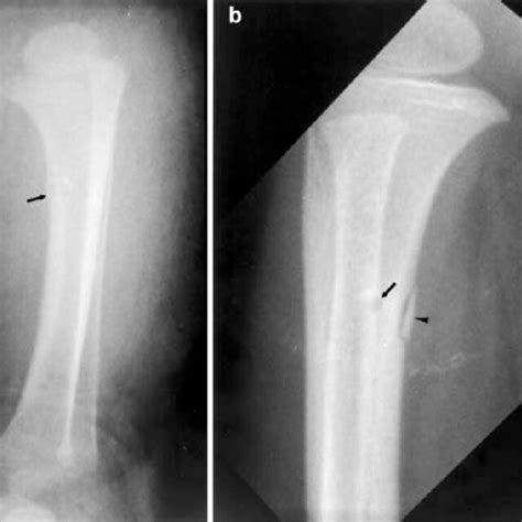 Patient 2 Anteroposterior Radiograph Of The Tibia Shows An Irregular