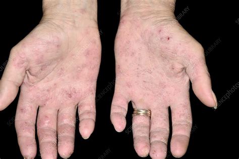Latex Allergy Skin Rash Stock Image C0478448 Science Photo Library