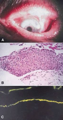 Pathology Of Conjunctiva Ento Key