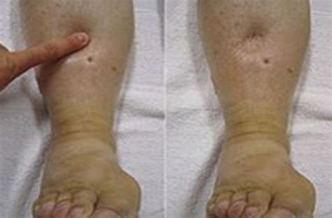 Deep vein thrombosis (dvt) occurs when a blood clot forms in one of the deep veins of your body, usually in your legs, but sometimes in your arm. Deep Vein Thrombosis (Blood Clot In The Leg)