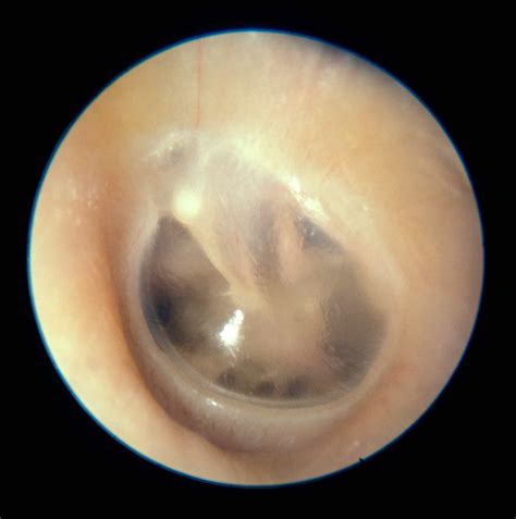 Ear Infections Misdiagnosed Overdiagnosed New Guidelines Released