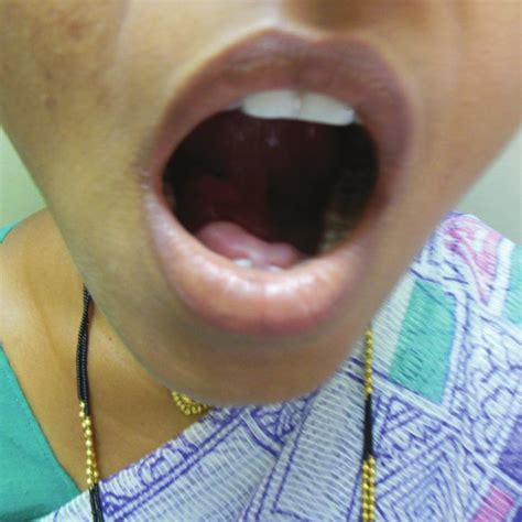 Photograph Of Patient With Tongue Lifted Showing Swelling In The Floor
