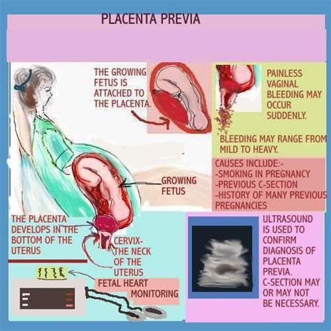 Nursing Nursing Care Plan Ncp Placenta Previa