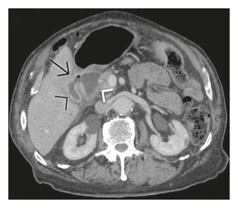 Unenhanced Computed Tomography In The Same Case Of Bouverets Syndrome