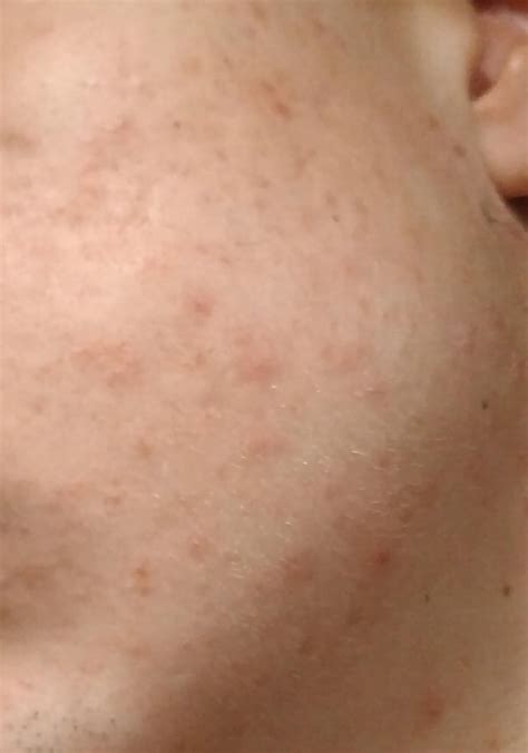 Acne Red Dots On Face Thats Not Pimples Rskincareaddiction