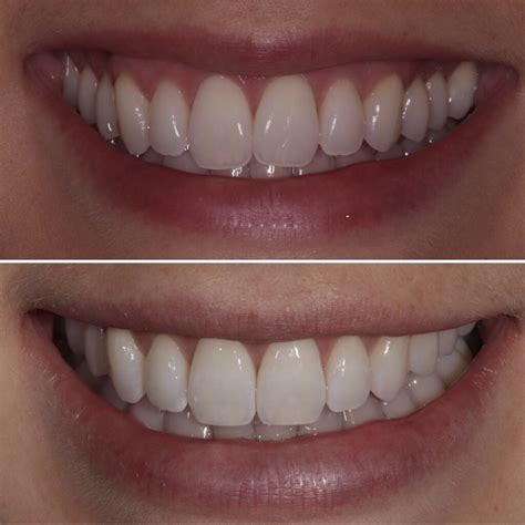 Everything You Need To Know About Emax Veneers Bespoke Smile