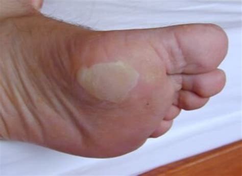 Blister Treatment Causes And Care