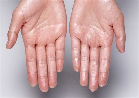 How To Stop Hyperhidrosis Skin Center Of South Miami