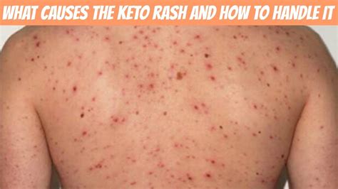 What Exactly Is A Keto Rash And How To Handle Youtube