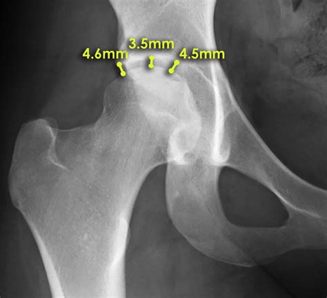 Hip Joint Space Measurement In An Anteroposterior Hip Radiograph