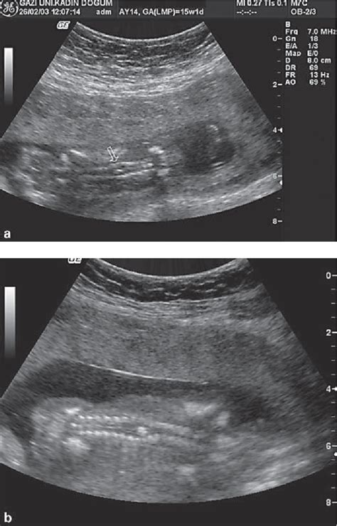 Prenatal Diagnosis Of Diastematomyelia In A 15 Week Old Fetus