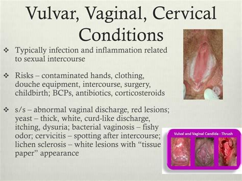 Ppt Benign Diseases Of The Vulva Vagina And Cervix Sexiz Pix