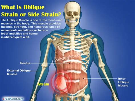 Oblique Strain Or Side Straincausessymptomstreatmentrecovery Period