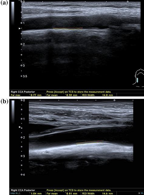 A Longitudinal Ultrasound Of The Right CCA In A Year Old Female Download Scientific Diagram