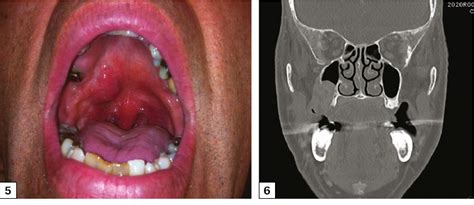Upper Palate Infection