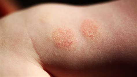 Difference Between Eczema And Ringworm My Xxx Hot Girl