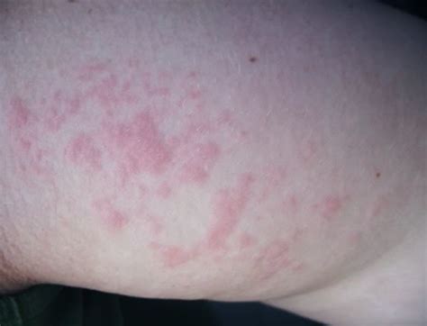 Image Gallery Lupus Rash On Body