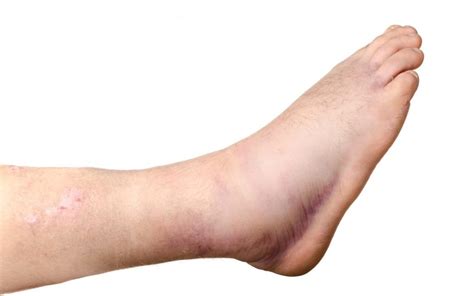 Broken Ankle Foot Doctor Marietta And Atlanta Area