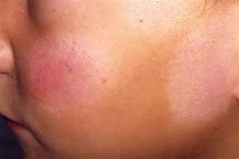 Patches of skin may be darker or lighter than your normal skin. White Spots on Face, Dots, Patches, Small, Pictures ...