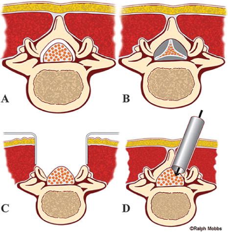 Outcomes After Decompressive Laminectomy For Lumbar Spinal Stenosis