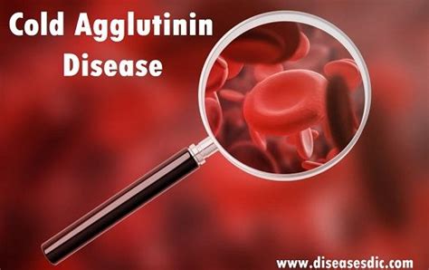 Cold Agglutinin Disease Cad Types Causes And Diagnosis