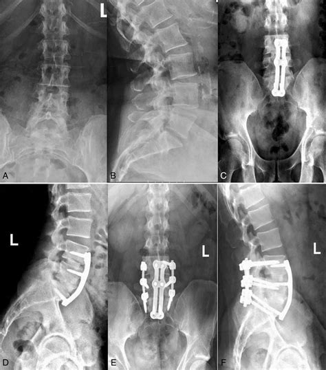 Lumbar Fusion X Ray