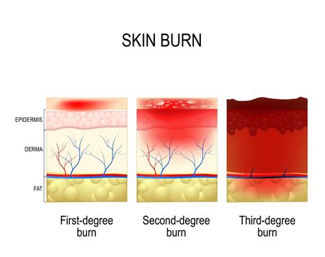Four Critical Steps To Burn Treatment When Burns Occur