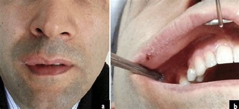 A Swelling And Asymmetry In The Right Side Of The Upper Lip Of The