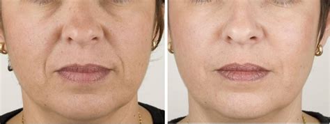 Teoxane Rha Fillers For Wrinkle Reduction In Washington Dc