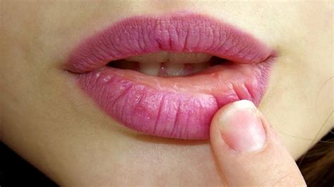 Cold Sores And Your Dental Visit Coombe Dental Care